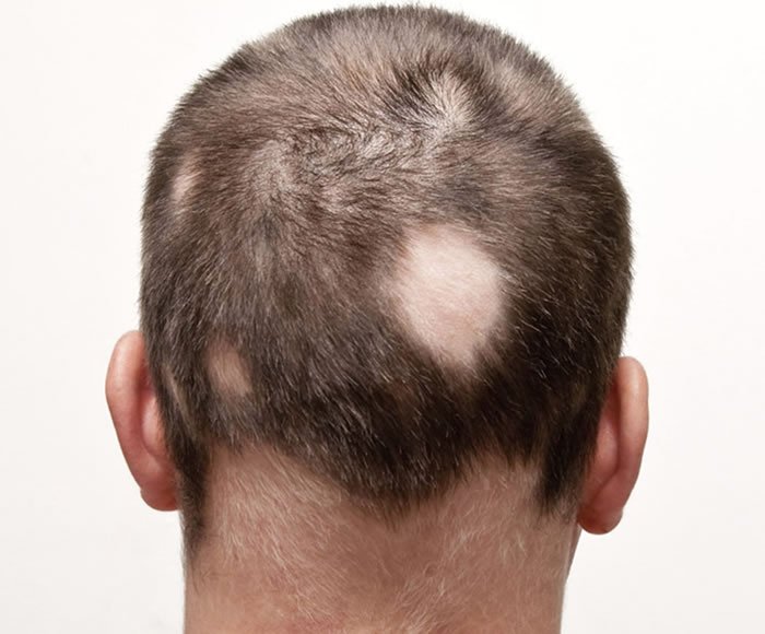 hair replacement services